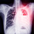 Chest X-ray Highlighting Lung Abnormality: shows a chest X-ray with a highlighted red area reveals left-sided pleural effusion