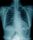 Chest x-ray , hight quality chest x-ray image Royalty Free Stock Photo