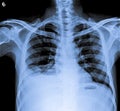 Chest X Ray of human body with right plural effusion.