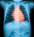 Chest X-ray imag of a young boy.