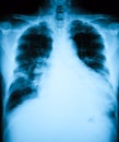 Chest X-ray image, AP upright view. Royalty Free Stock Photo