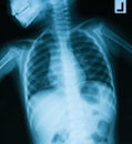 Chest X-ray image, AP view. Royalty Free Stock Photo