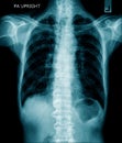 Chest x-ray image in blue tone Royalty Free Stock Photo