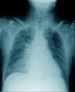 Chest x-ray image in blue tone Royalty Free Stock Photo