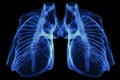 Chest x-ray image of dextrocardia and situs inversus patient that demonstrated heart,lungs,ribs,bones and muscles look like Royalty Free Stock Photo