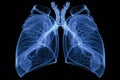 Chest x-ray image of dextrocardia and situs inversus patient that demonstrated heart,lungs,ribs,bones and muscles look like