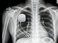 Chest x-ray showing a pacemaker with attached leads in a human patient Royalty Free Stock Photo