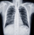 Chest X-ray or X-Ray Image Of Human Chest .