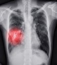 Chest X-ray or X-Ray Image Of Human Chest showing tuberculosis. Royalty Free Stock Photo