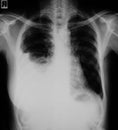 Chest X-ray image of Lung infection. Royalty Free Stock Photo