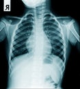 Chest x-ray image with lung view in blue tone Royalty Free Stock Photo