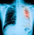 Chest X-ray image, PA upright position. Royalty Free Stock Photo
