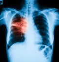 Chest X-ray image, PA upright position.