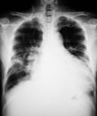 Chest X-ray image. Royalty Free Stock Photo