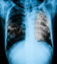 Chest x-ray image of a patient with pulmonary tuberculosis. Royalty Free Stock Photo