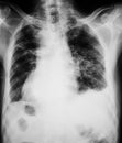 Chest x-ray image showing lung infection. Royalty Free Stock Photo