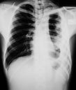 Chest x-ray image showing lung infection. Royalty Free Stock Photo