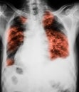 Chest x-ray image showing lungs infection. Royalty Free Stock Photo