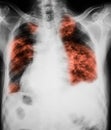 Chest x-ray image showing lungs infection.