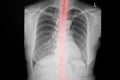 Chest X-ray image. X-Ray Image Of Human Chest