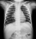 Chest X-ray image of a young boy. Royalty Free Stock Photo