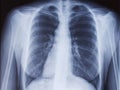 Chest x-ray, lungs infection, pulmorany disease covid-19 new coronavirus illustration