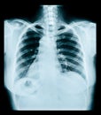 Chest x ray. Royalty Free Stock Photo