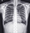 Chest x-ray normal,medical concept. Royalty Free Stock Photo