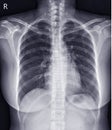 Chest x-ray normal,medical concept. Royalty Free Stock Photo