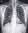 Chest x-ray normal,medical concept. Royalty Free Stock Photo