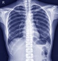 Chest x-ray normal,medical concept. Royalty Free Stock Photo