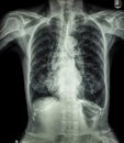 Chest X-ray of old patient ( calcification at rib , trachea , bronchus )