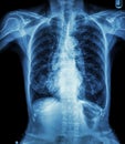 Chest X-ray of old patient ( calcification at rib , trachea , bronchus ) Royalty Free Stock Photo