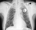 Chest X ray with pacemeker