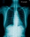 High quality chest x-ray and shoulder and clavicle