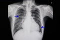 chest x-ray of a patient with heart failure Royalty Free Stock Photo