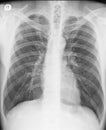 Chest X-ray. Posteroanterior view. Two years after spontaneous pneumothorax.