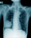 Chest x-ray lobectomy