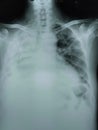 Chest X ray show massive pleural effusion