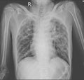 Chest x-ray showing Interstitial pulmonary infiltration with dry cavities both lungs Pulmonary tuberculosis Royalty Free Stock Photo