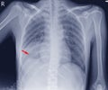 Chest X-ray Showing Mass Rt,lower lung field likely loculateraled pleural effusion Trachea Royalty Free Stock Photo