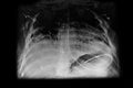 Chest X- ray showing nasogastric tube dobhoff for feeding