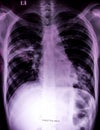 Chest x-ray showing patchy opacification.