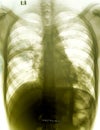 Chest x-ray showing patchy opacification.