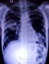 Chest x-ray showing patchy opacification. Royalty Free Stock Photo