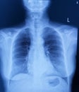 Chest x-ray upright,There is no pulmonary in filtration,Normal heart size.Both costophrenic angles are clear.In osseous structure. Royalty Free Stock Photo