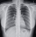 Chest x-ray woman normal . Royalty Free Stock Photo