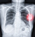 Chest X-ray or X-Ray Image Of Human Chest with pacemaker placement Royalty Free Stock Photo