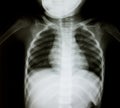 Chest x-ray of young boy Royalty Free Stock Photo