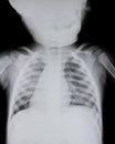 Chest x-ray of young boy. Royalty Free Stock Photo